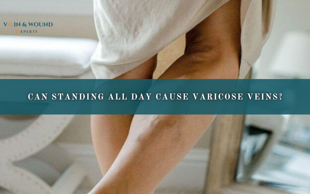 Can Standing All Day Cause Varicose Veins?