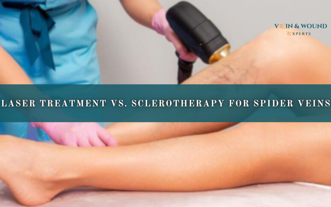 Laser Treatment vs. Sclerotherapy for Spider Veins