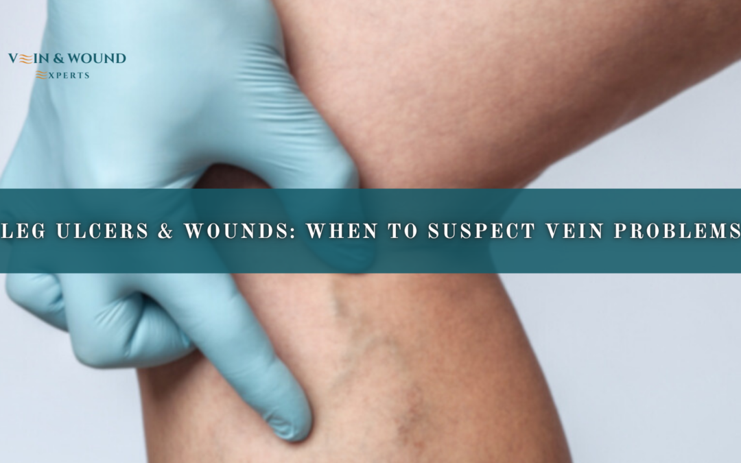 Leg Ulcers & Wounds: When to Suspect Vein Problems