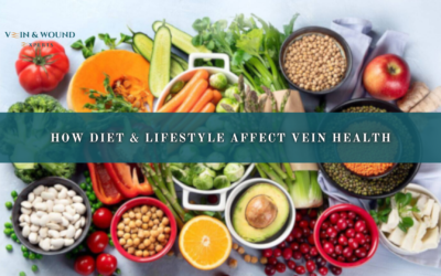 How Diet & Lifestyle Affect Vein Health