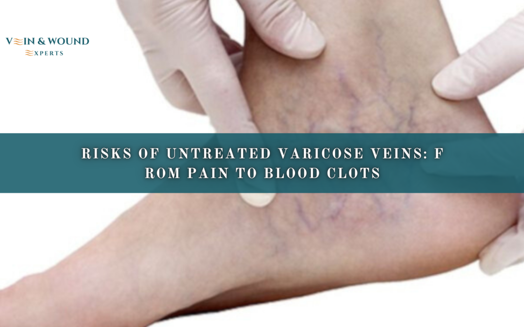 Risks of Untreated Varicose Veins: From Pain to Blood Clots