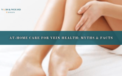 At-Home Care for Vein Health: Myths & Facts