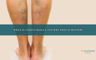 What Is Venous Reflux and Why Does It Matter?