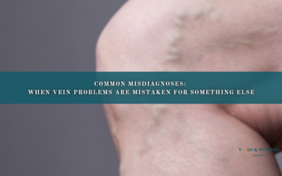 Common Misdiagnoses: When Vein Problems Are Mistaken for Something Else