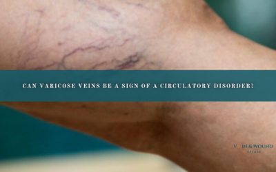 Can Varicose Veins Be a Sign of a Circulatory Disorder?