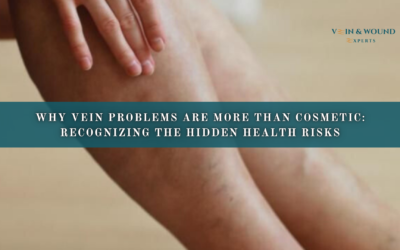 Why Vein Problems Are More Than Cosmetic: Recognizing the Hidden Health Risks