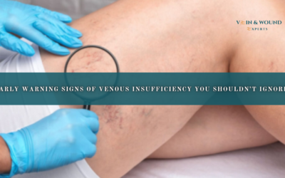 Early Warning Signs of Venous Insufficiency You Shouldn’t Ignore