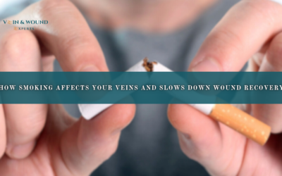 How Smoking Affects Your Veins and Slows Down Wound Recovery
