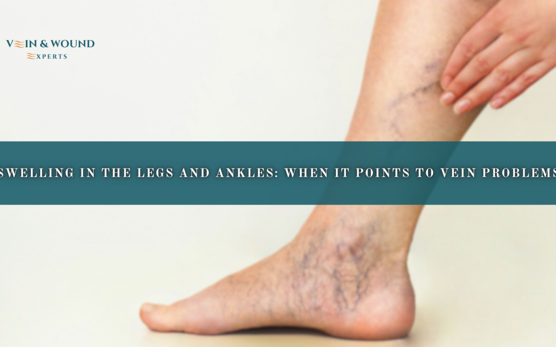 Swelling in the Legs and Ankles: When It Points to Vein Problems