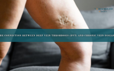 The Connection Between Deep Vein Thrombosis (DVT) and Chronic Vein Disease