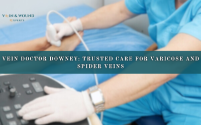 Vein Doctor Downey: Trusted Care for Varicose and Spider Veins