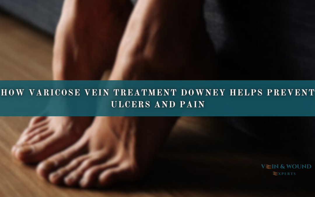 How Varicose Vein Treatment in Downey Helps Prevent Ulcers and Pain