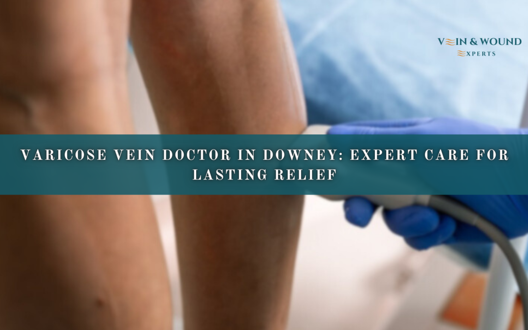 Varicose Vein Doctor Downey: Expert Care for Lasting Relief