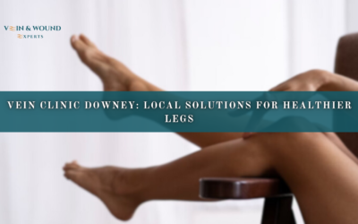 Vein Clinic Downey: Local Solutions for Healthier Legs