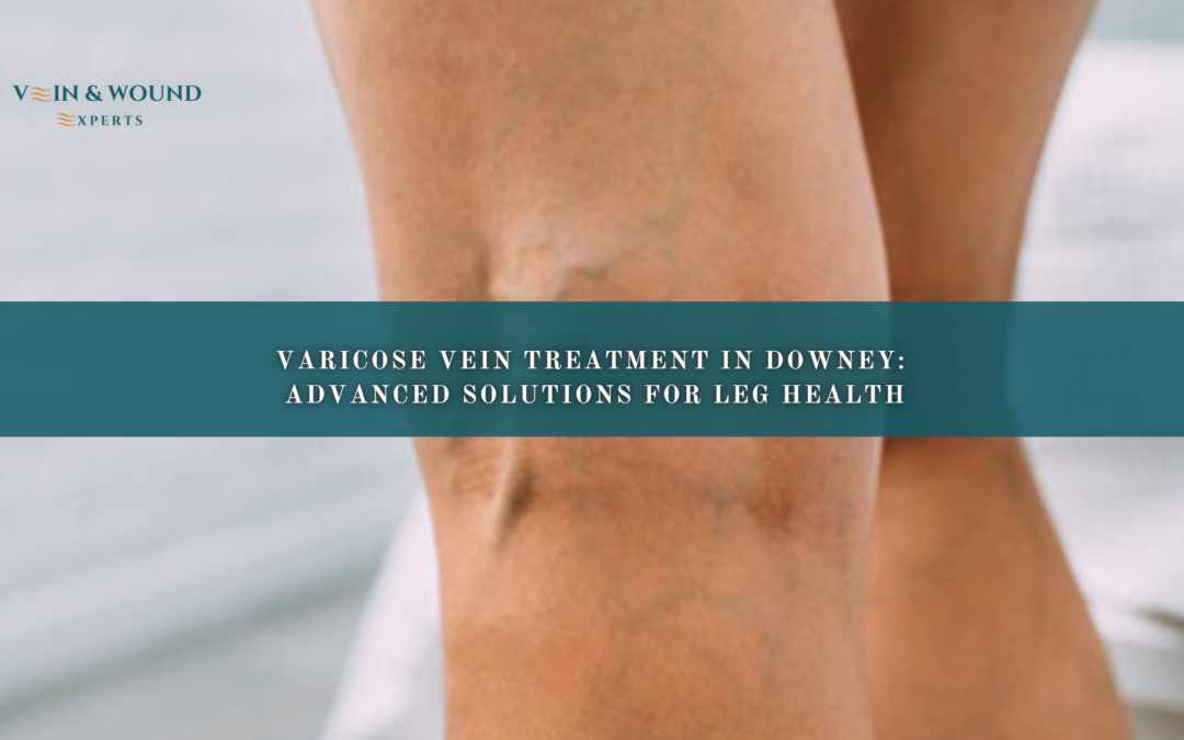 Varicose Vein Treatment in Downey: Advanced Solutions for Leg Health
