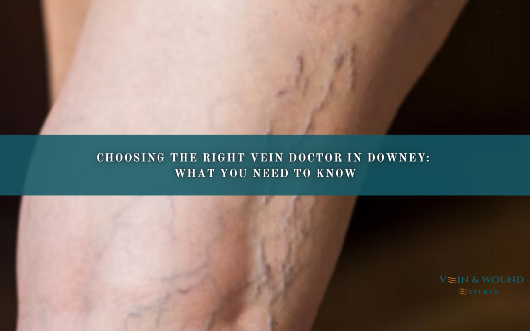 Choosing the Right Vein Doctor in Downey: What You Need to Know