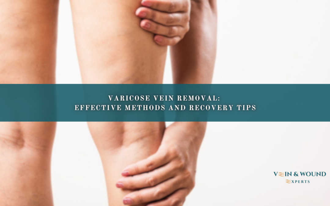 Varicose Vein Removal: Effective Methods and Recovery Tips