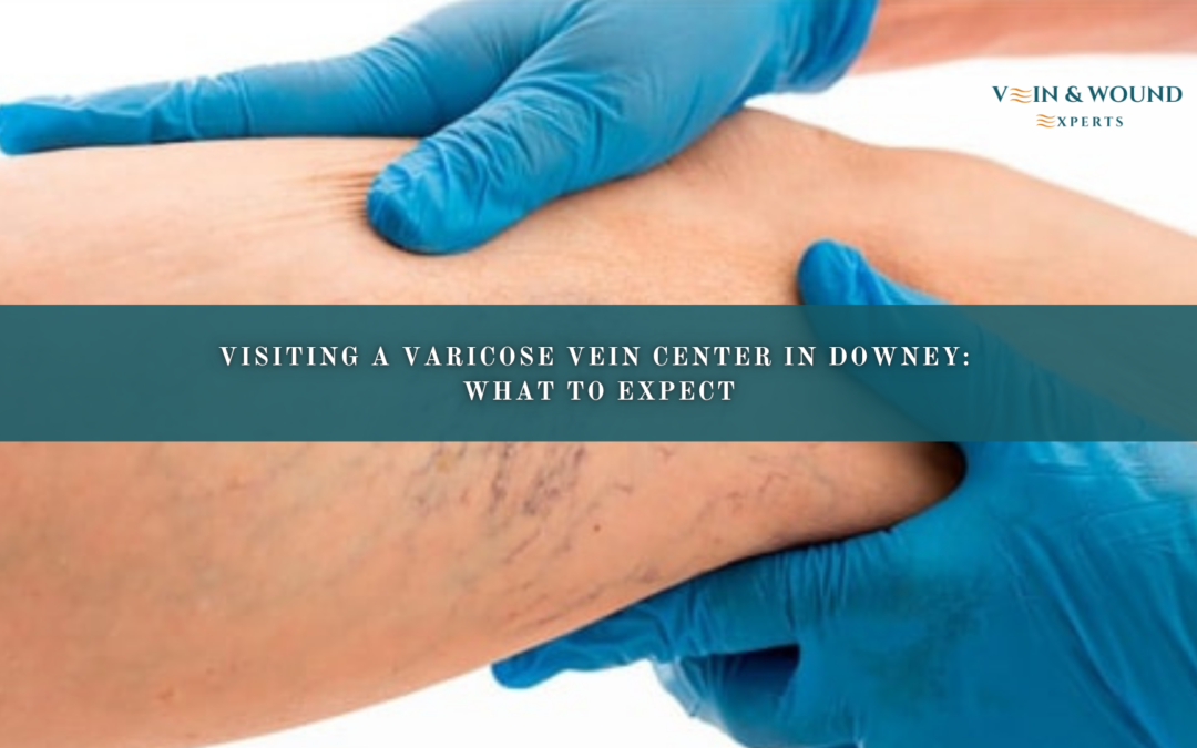 Visiting a Varicose Vein Center in Downey: What to Expect