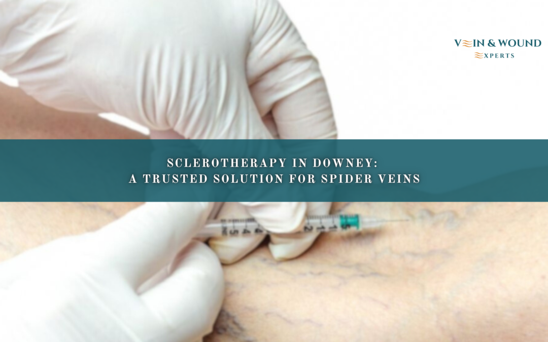 Sclerotherapy in Downey: A Trusted Solution for Spider Veins