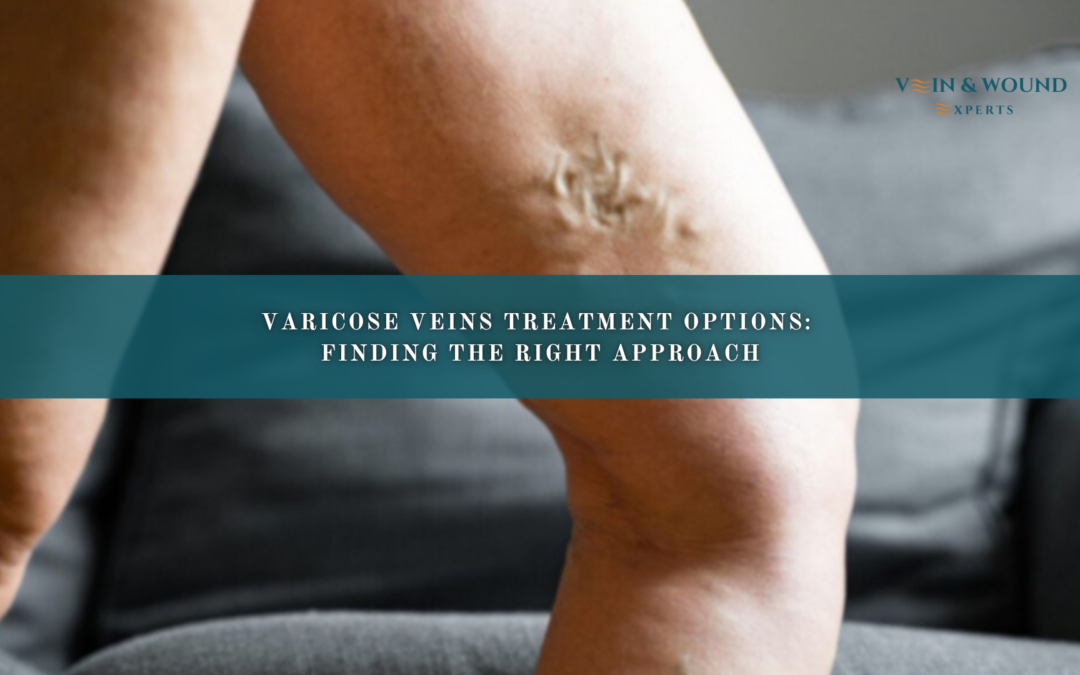 Varicose Veins Treatment Options: Finding the Right Approach