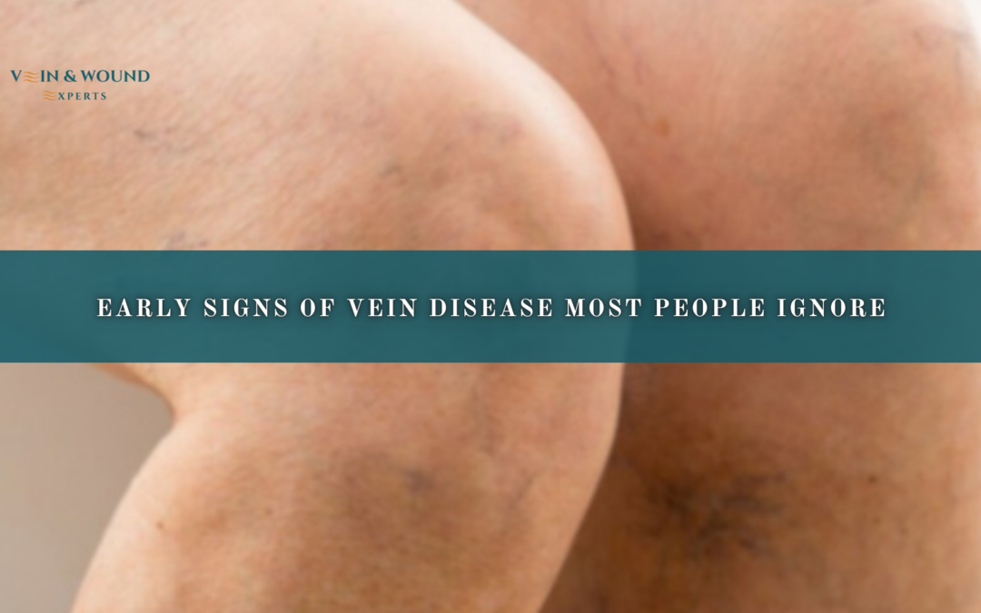 Early Signs of Vein Disease Most People Ignore