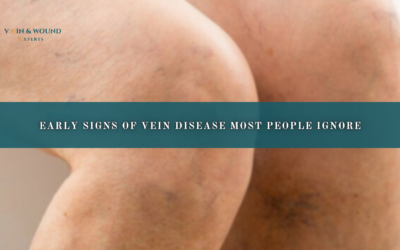 Early Signs of Vein Disease Most People Ignore