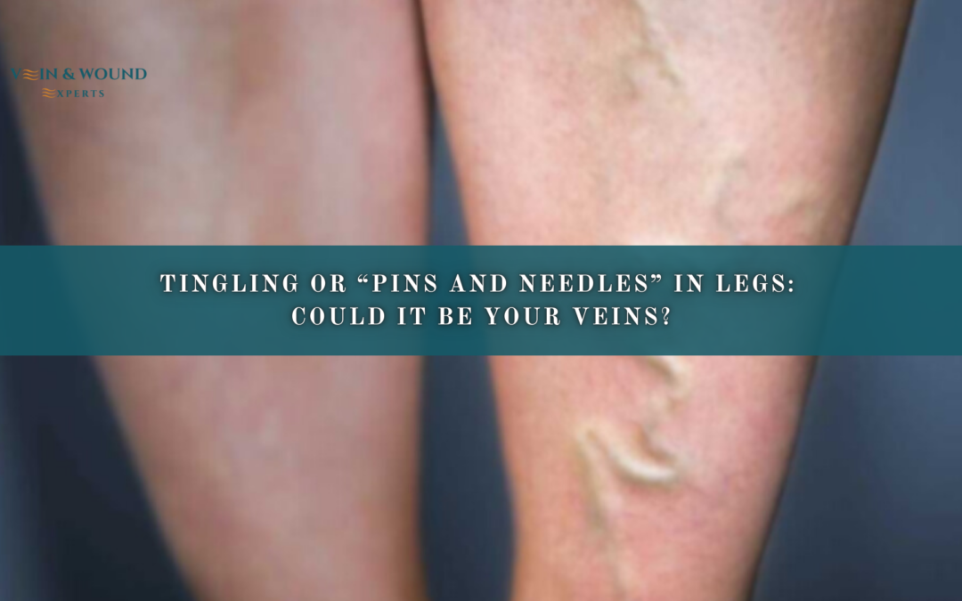 Tingling or “Pins and Needles” in Legs: Could It Be Your Veins?