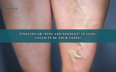 Tingling or “Pins and Needles” in Legs: Could It Be Your Veins?