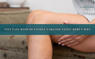 Vein Pain With No Visible Varicose Veins? Here’s Why.