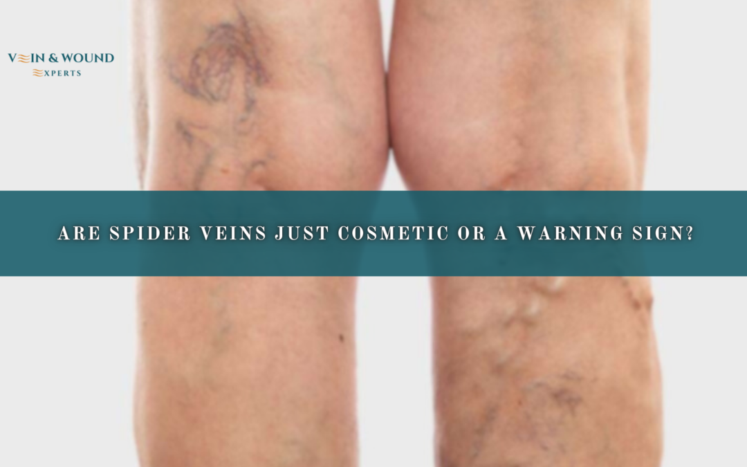 Are Spider Veins Just Cosmetic or a Warning Sign?