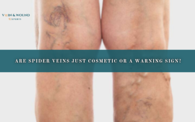 Are Spider Veins Just Cosmetic or a Warning Sign?