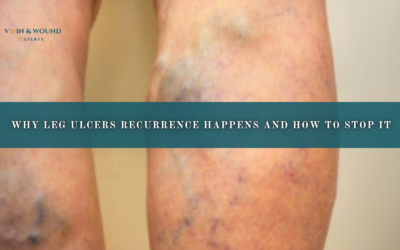 Why Leg Ulcers Recurrence Happens and How to Stop It