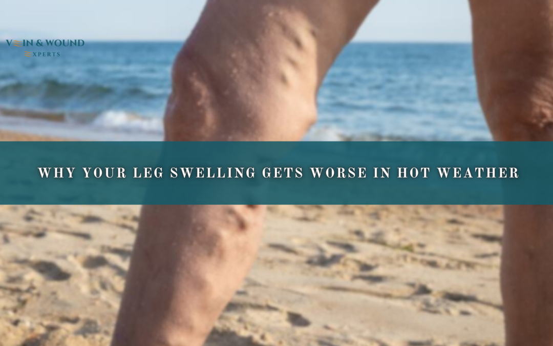 Why Your Leg Swelling Gets Worse in Hot Weather