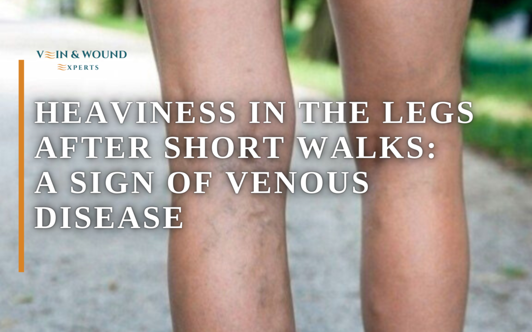 Heaviness in the Legs After Short Walks: A Sign of Venous Disease