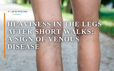 Heaviness in the Legs After Short Walks: A Sign of Venous Disease