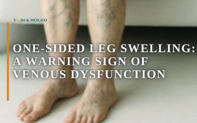 One-Sided Leg Swelling: A Warning Sign of Venous Dysfunction