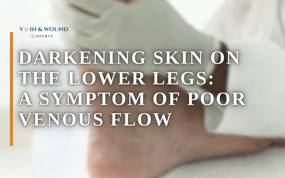Darkening Skin on the Lower Legs: A Symptom of Poor Venous Flow
