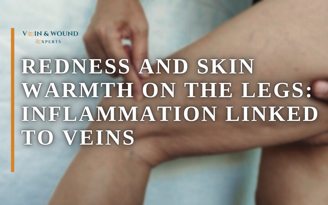 Redness and Skin Warmth on the Legs: Inflammation Linked to Veins