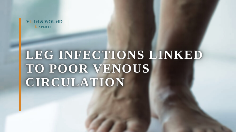Leg Infections Linked to Poor Venous Circulation