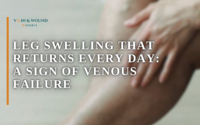 Leg Swelling That Returns Every Day: A Sign of Venous Failure