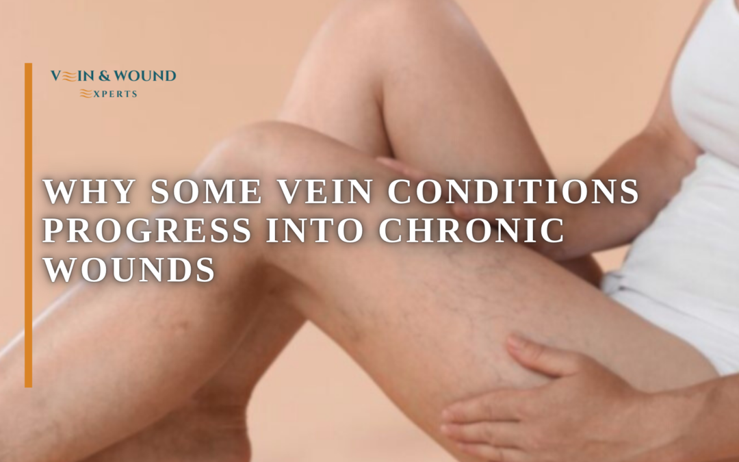 Why Some Vein Conditions Progress Into Chronic Wounds