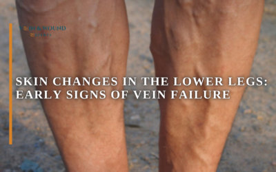 Skin Changes in the Lower Legs: Early Signs of Vein Failure