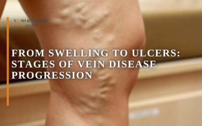 From Swelling to Ulcers: Stages of Vein Disease Progression