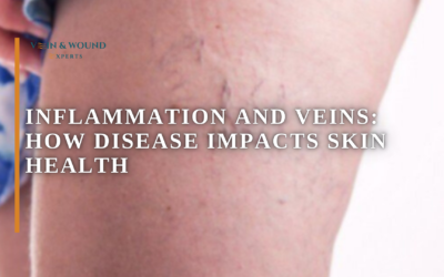 Inflammation and Veins: How Disease Impacts Skin Health