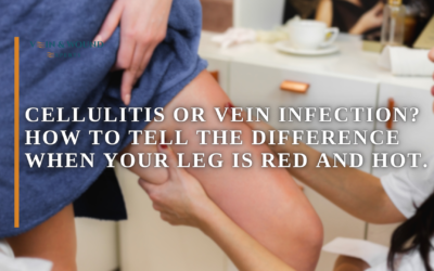 Cellulitis or Vein Infection? How to Tell the Difference When Your Leg is Red and Hot.