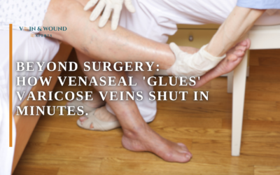Beyond Surgery: How VenaSeal ‘Glues’ Varicose Veins Shut in Minutes.