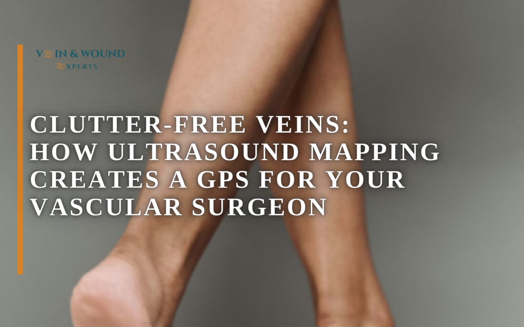 Clutter-Free Veins: How Ultrasound Mapping Creates a GPS for Your Vascular Surgeon