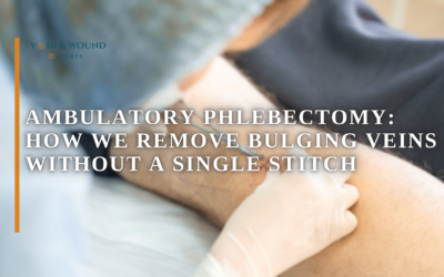 Ambulatory Phlebectomy: How We Remove Bulging Veins Without a Single Stitch