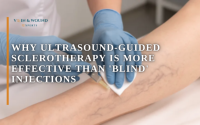 Why Ultrasound-Guided Sclerotherapy is More Effective Than ‘Blind’ Injections