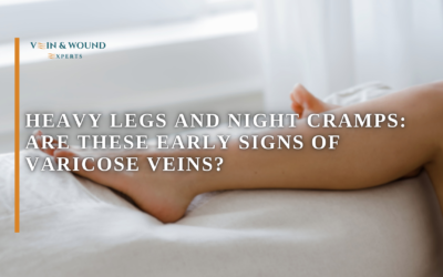 Heavy Legs and Night Cramps: Are These Early Signs of Varicose Veins?